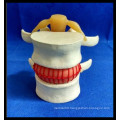 Enlarge Demonstration Lumbar Disc Herniation Model